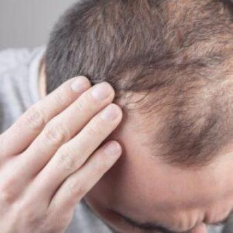 Пересадка волос для мужчин и женщин